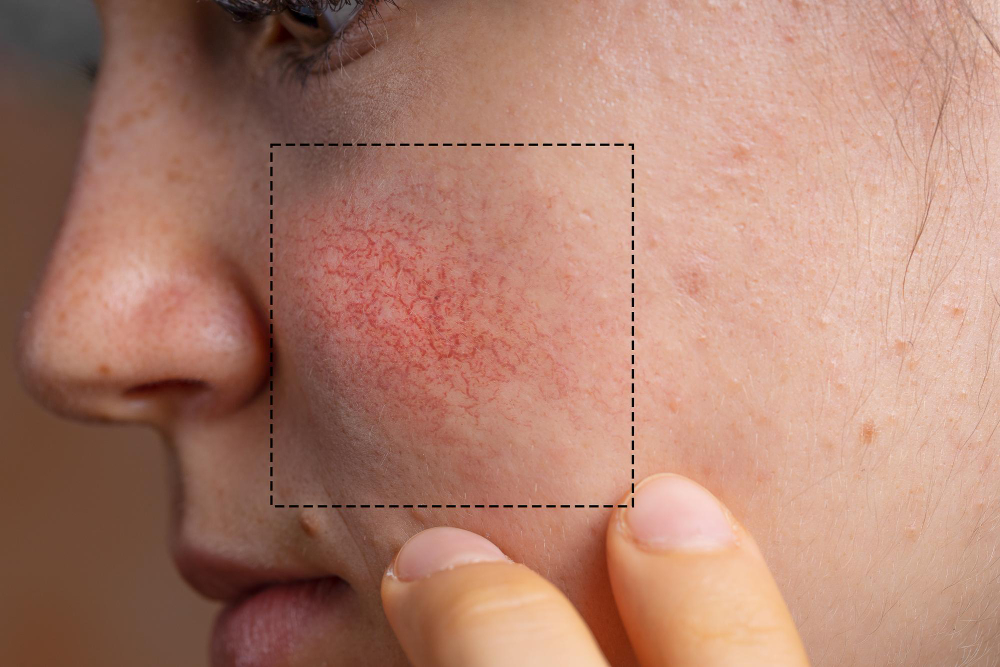 rosacea